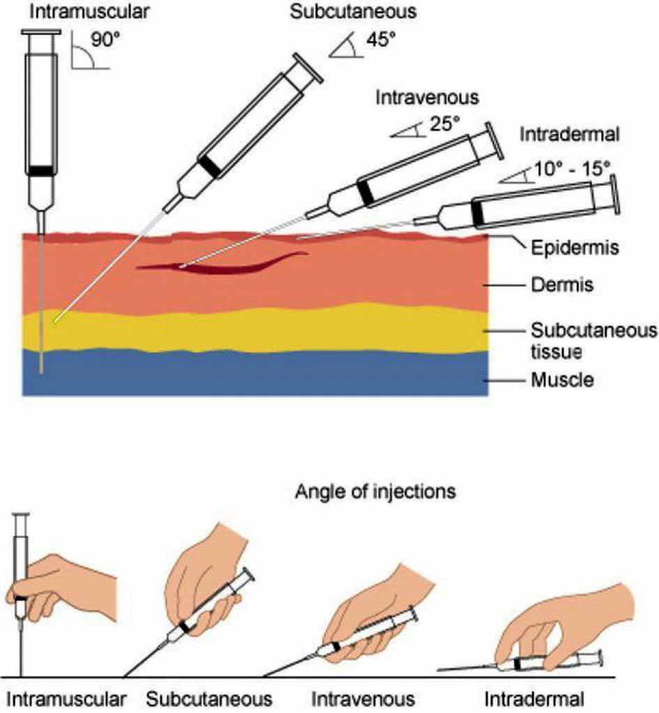 Diagram showing different injection types including subcutaneous and intramuscular